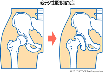 変形性股関節症