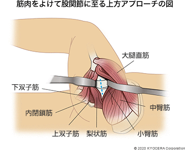 筋肉をよけて股関節に至る上方アプローチの図