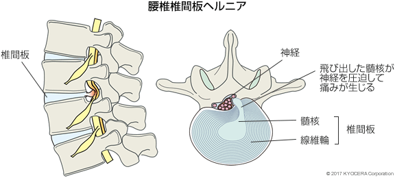 腰椎椎間板ヘルニア