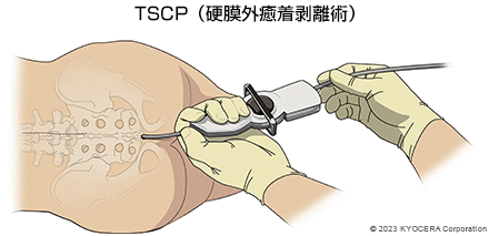 TSCP（硬膜外癒着剝離術）