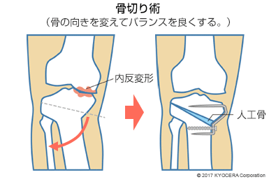 骨切り術