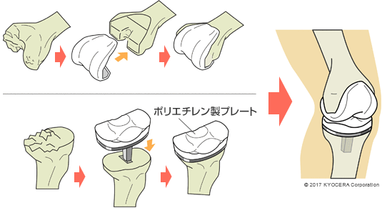 人工膝関節全置換術（TKA）