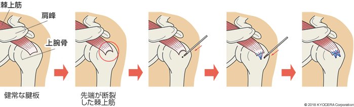 腱板を修復する手術
