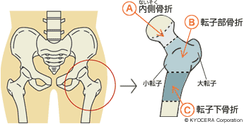 大腿骨骨折