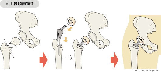人工骨頭置換術