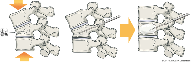 BKP（経皮的椎体形成術）