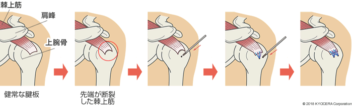 腱板を縫合する手術の例