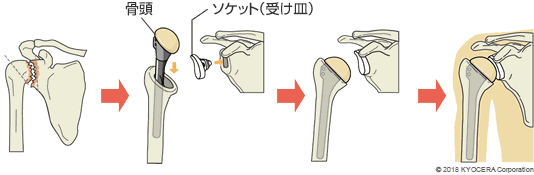 従来タイプの人工肩関節置換術の例