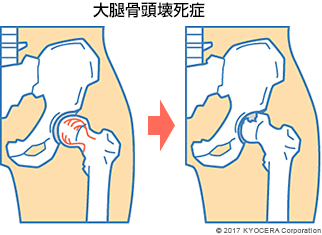 大腿骨頭壊死症