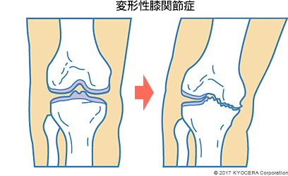 変形性膝関節症