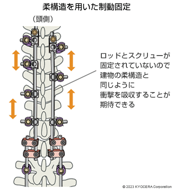 柔構造を用いた制動固定