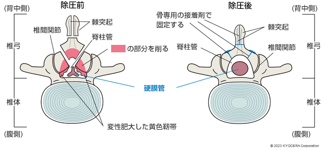 還納式椎弓形成術