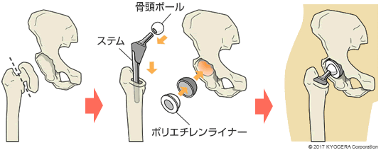 人工股関節置換術の例