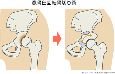 寛骨臼回転骨切り術