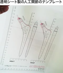 透明シート製の人工関節のテンプレート