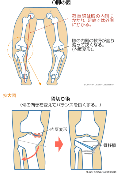 O脚の図