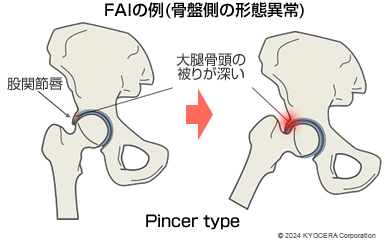 FAIの例（骨盤側の形態異常）