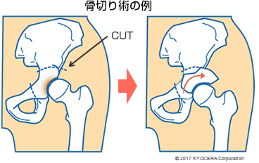 骨切り術の例