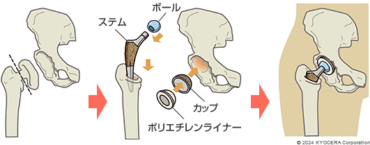 人工股関節置換術の例