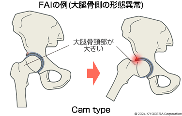 FAIの例（大腿骨側の形態異常）