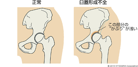 正常 臼蓋形成不全