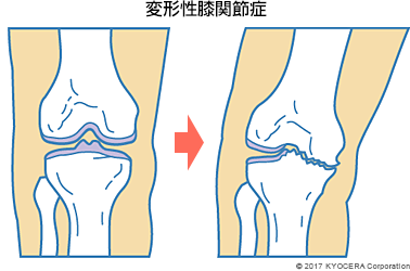 変形性膝関節症