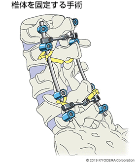 椎体を固定する手術