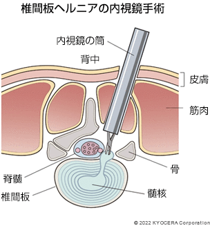椎間板ヘルニアの内視鏡手術