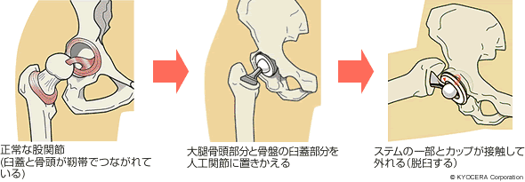 人工股関節置換術 藤田 貴也 今では人工股関節のゆるみや脱臼のリスクはかなり低減し 若い層にも手術が行えるようになりました