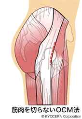 筋肉を切らないOCM法