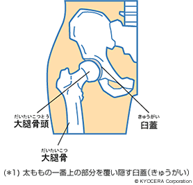 (＊1) 太ももの一番上の部分を覆い隠す臼蓋（きゅうがい）