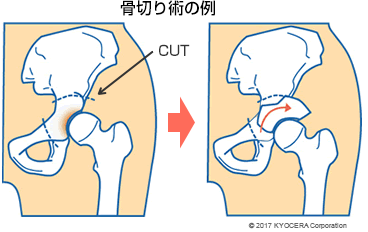 骨切り術の例