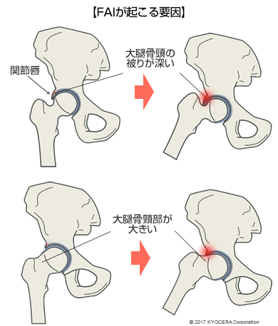 FAIが起こる要因