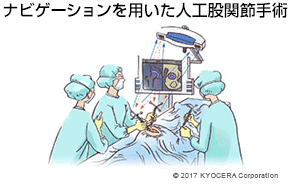 ナビゲーションを用いた人工股関節手術