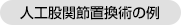 人工股関節置換術の例