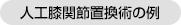 人工膝関節置換術の例