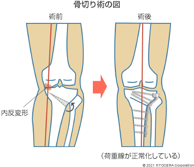 骨切り術の図