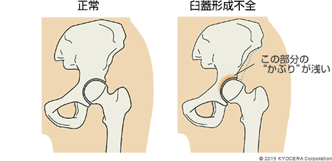 正常 臼蓋形成不全
