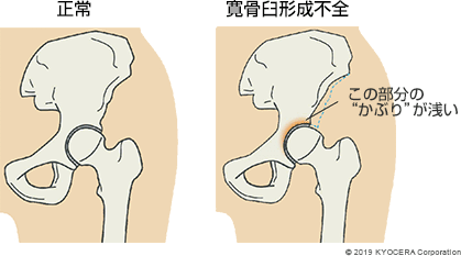 正常　寛骨臼形成不全
