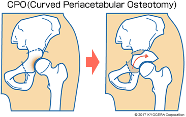 CPO(Curved Periacetabular Osteotomy)