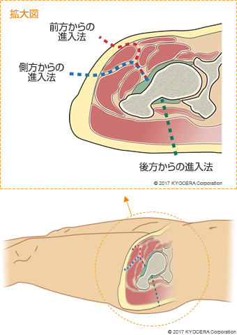 前方からの進入法　側方からの進入法　後方からの進入法