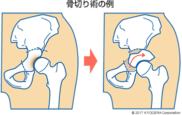 骨切り術の例