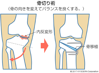 骨切り術（骨の向きを変えてバランスを良くする。）