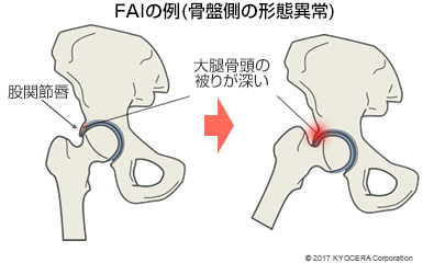 FAIの例（骨盤側の形態異常）