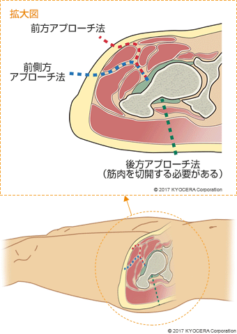 前方アプローチ法　前側方アプローチ法　後方アプローチ法（筋肉を切開する必要がある）