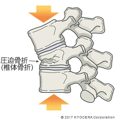 圧迫骨折（椎体骨折）