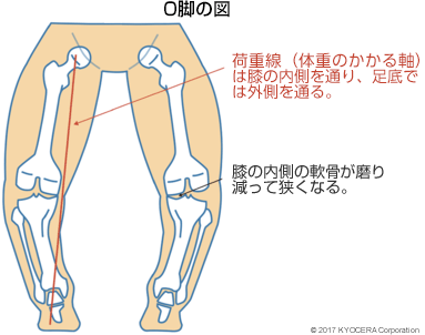 O脚の図