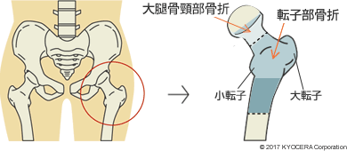 大腿骨頸部骨折・転子部骨折