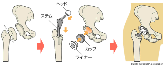 人工股関節置換術の例
