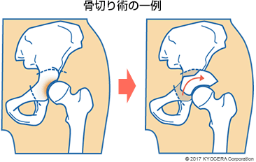 骨切り術の一例